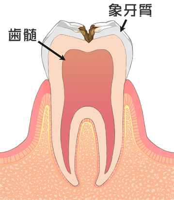 虫歯の中期